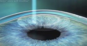 眼膜医学动画制作